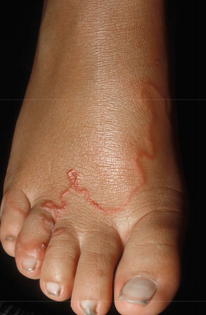 Cutaneous Larva Migrans - Serpigineuze track