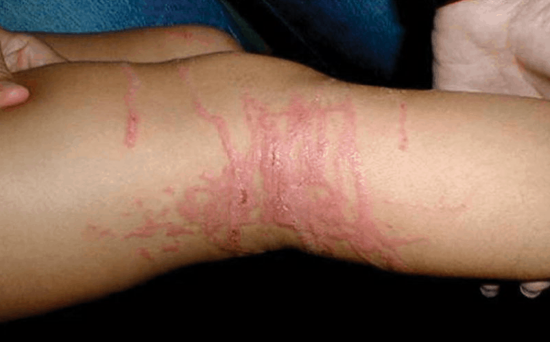 Jellyfish sting - Lineaire tentakel patronen