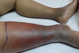 Cellulitis - erytheem en zwelling onderbeen