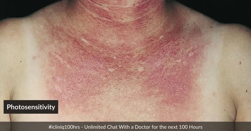 Fotosensitiviteit - Phototoxische reactie