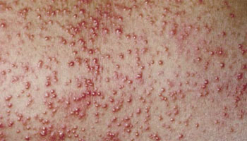 Miliaria rubra - Prickly heat