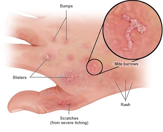 Scabies - Gangetjes en excoriaties
